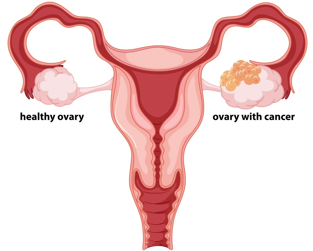 Ovarian Cancer