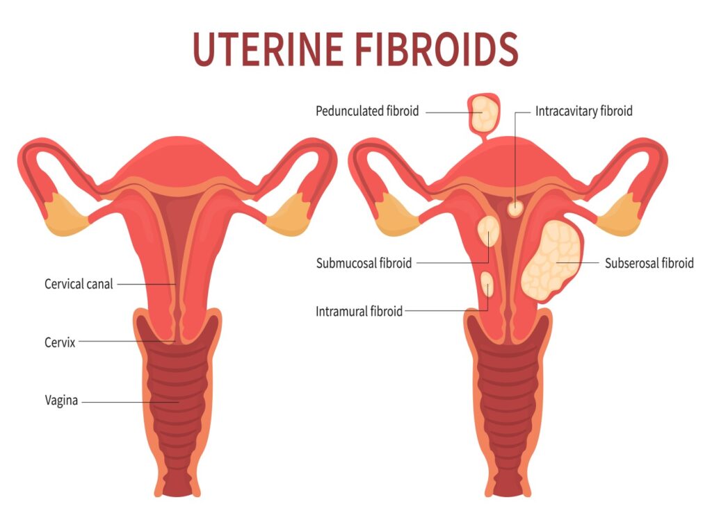 Uterine Fibroids_99